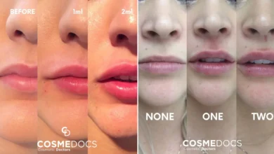 Lip Fillers