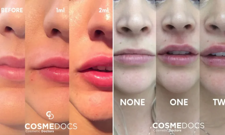 Lip Fillers